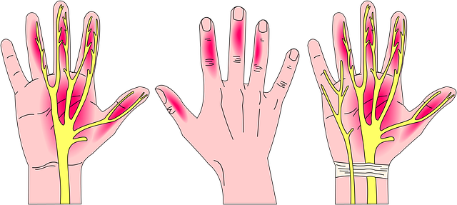 Carpal Tunnel Syndrome: Prevention Techinques